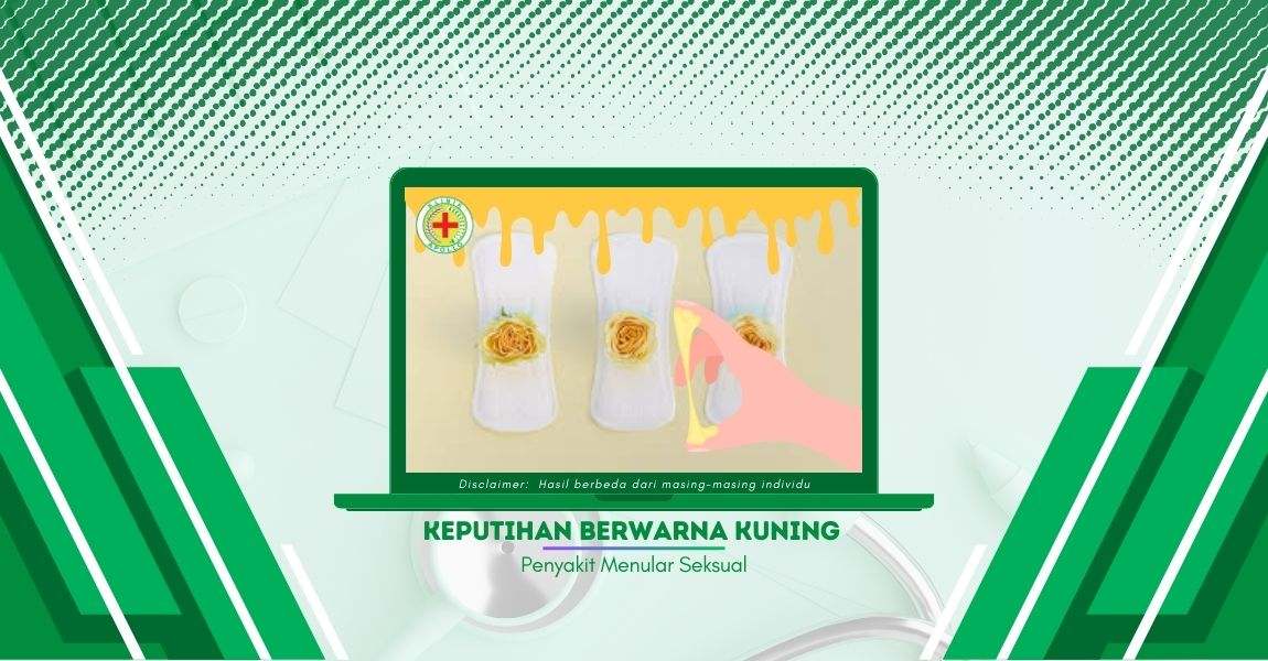 Kenali Keputihan Berwarna Kuning, Bisa Disertai Nyeri dan Gatal