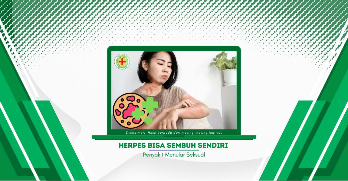 Herpes Bisa Sembuh Sendiri Tanpa Harus Diobati, Benarkah?