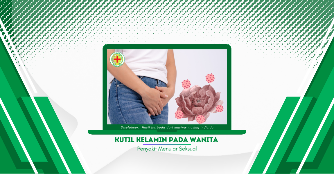 Kutil Kelamin pada Wanita