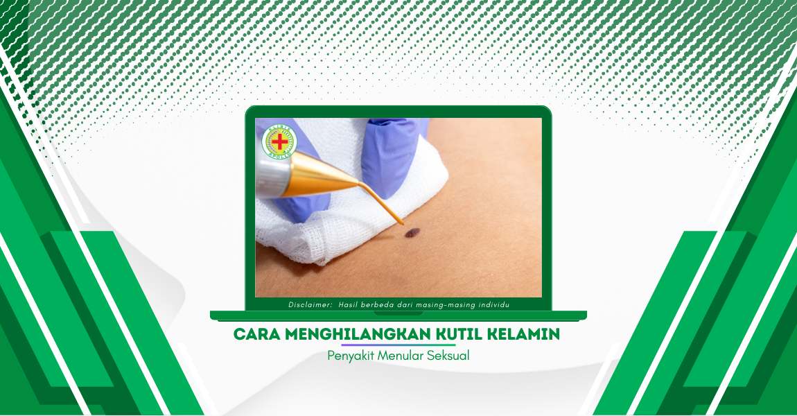 Cara Menghilangkan Kutil Kelamin agar Tidak Tumbuh Lagi