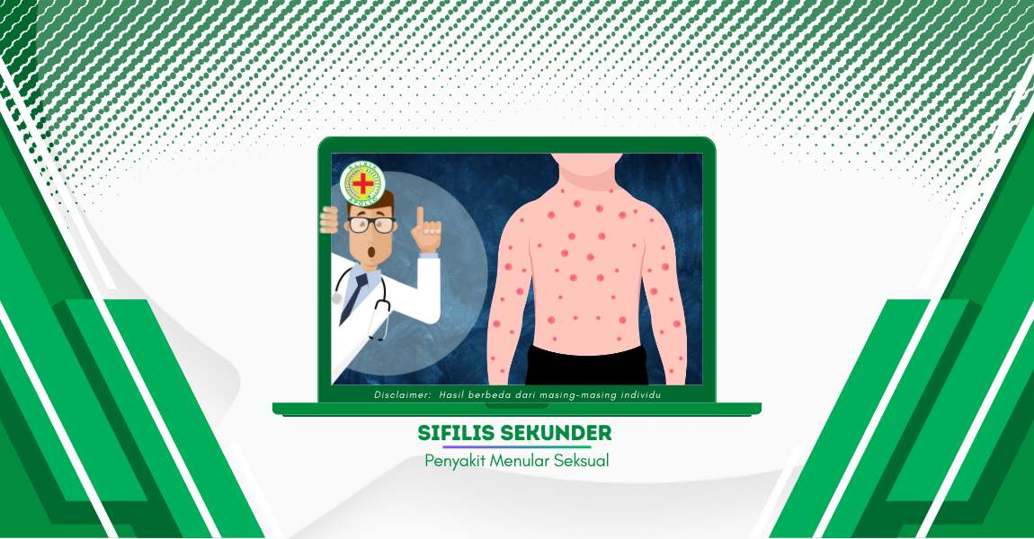 Rambut Bisa Rontok, Inilah Gejala Sifilis Sekunder, Waspadai