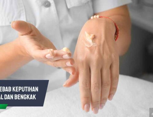 5 Penyebab Keputihan Gatal dan Bengkak yang Perlu Diketahui