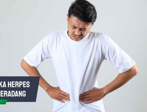 Waspadai! Luka Herpes Meradang Bisa Menyebar dan Menular