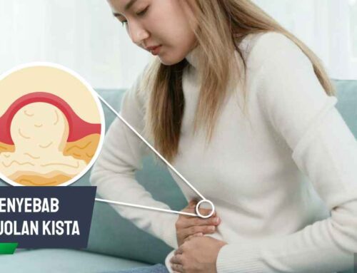 Kenali Penyebab Benjolan Kista dan Cara Mengatasinya