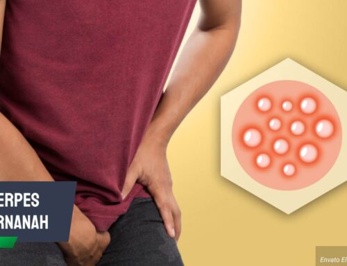 Kenali Ciri-Ciri Herpes Bernanah dan Langkah Pengobatannya