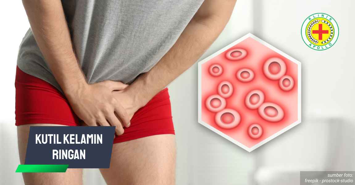 Ilustrasi Kutil Kelamin Ringan.