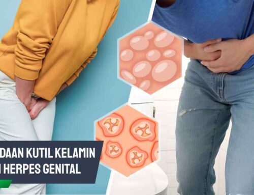 Perbedaan Kutil Kelamin dan Herpes Genital, Ini Penjelasannya
