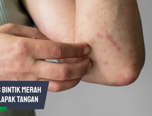 Waspada Sifilis Bintik Merah di Telapak Tangan, Ini Cirinya
