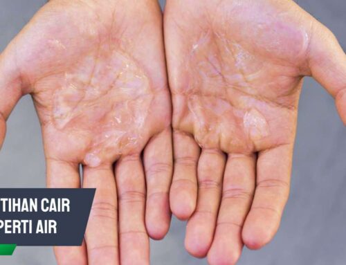 Kenali Penyebab Keputihan Cair Seperti Air & Tandanya
